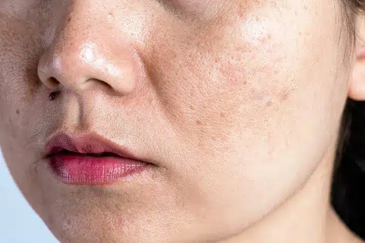 Best Treatment for Large Pores and Wrinkles