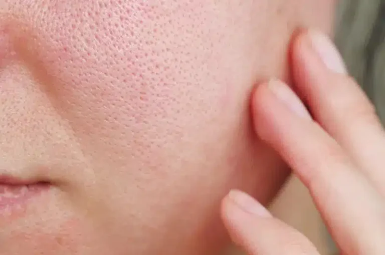 Best Treatment for Large Pores and Wrinkles