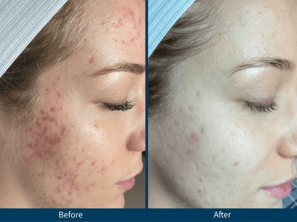 Microneedling for Scars - Does it Work? before and after