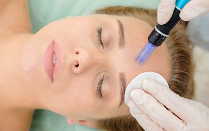 Microneedling for Scars - Does it Work?