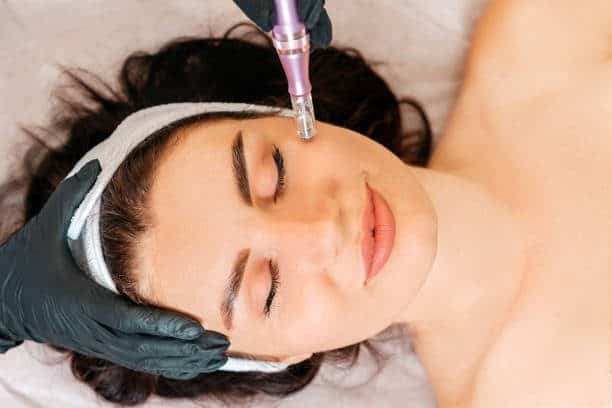 Microneedling for Scars - Does it Work?