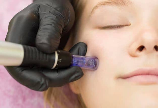 microneedling for scars before and after