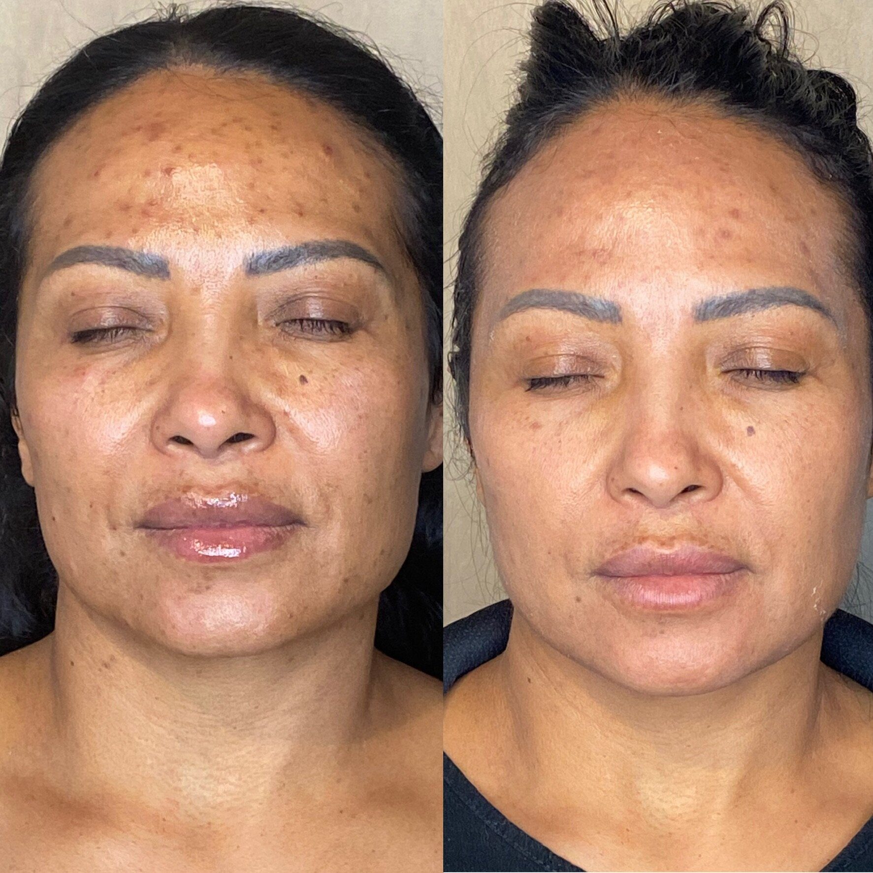 microdermabrasion before and after
