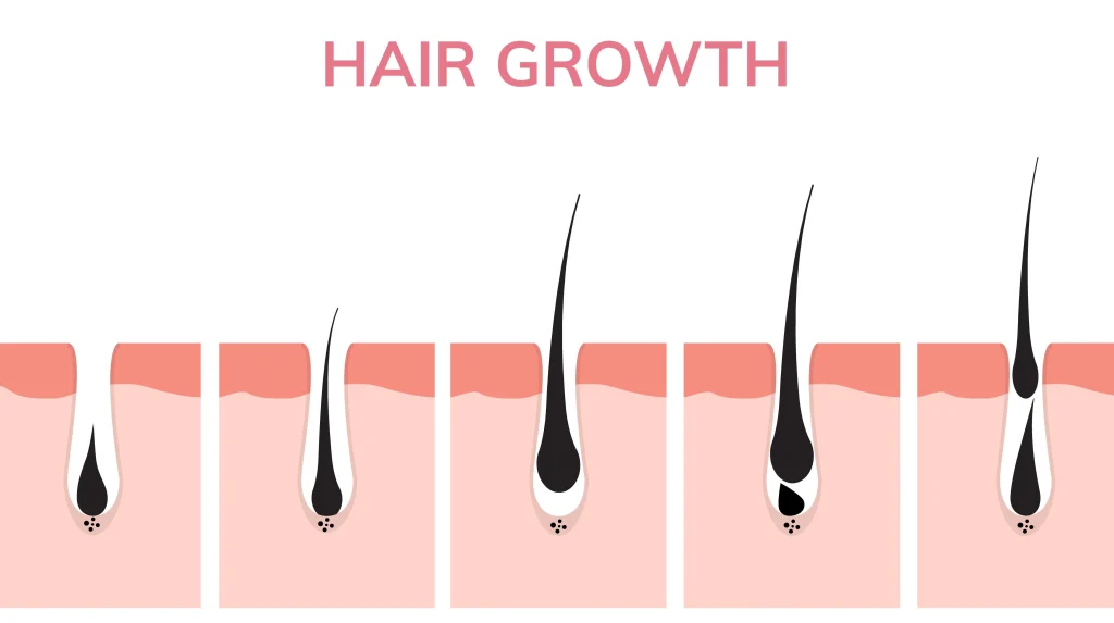 After Laser Hair Removal: When Does Hair Fall Out?